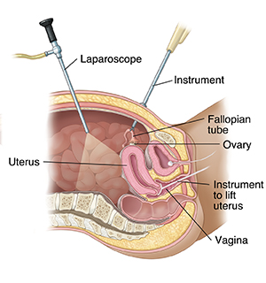 Cross section of female pelvis from the side showing laparoscopy.