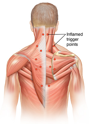 Male torso showing muscles of back with inflamed trigger points.