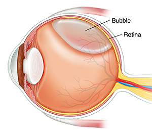 Side view cross section of eye showing gas bubble in vitreous.