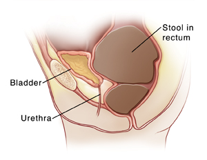 Child's pelvis showing urethra, bladder full of urine, and rectum behind bladder. Large amount of stool is in rectum. 