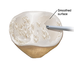 Back view of patella showing instrument removing damaged cartilage. 