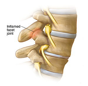 Side view of three vertebrae showing inflamed facet joint.