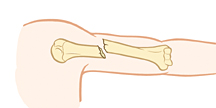 Krames Online - Tipos De Fracturas Más Comunes